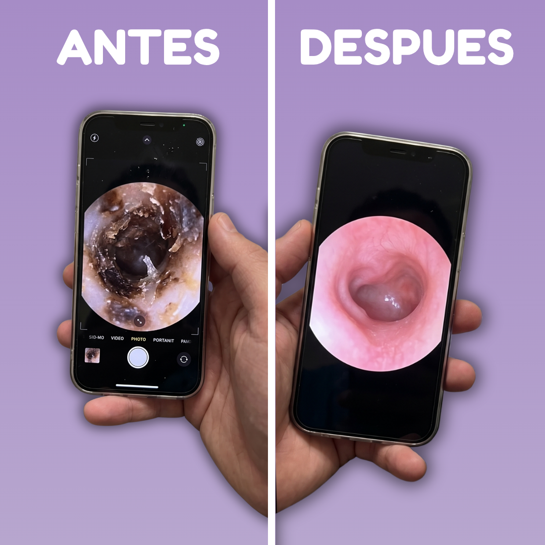 👂 KIT DE HIGIENE AUDITIVA INTELIGENTE (Oferta Exclusiva)
